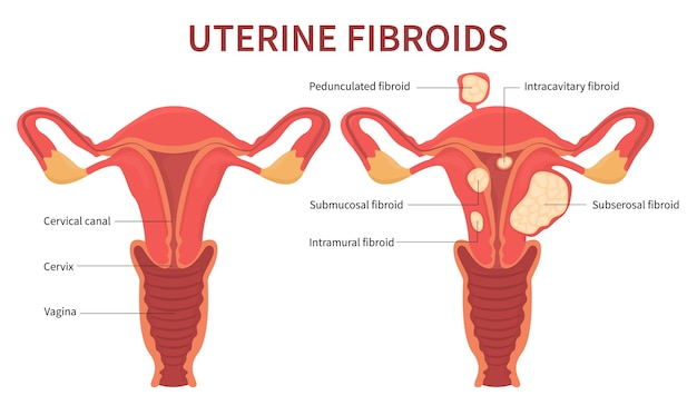 Reproductive system with uterine fibroids