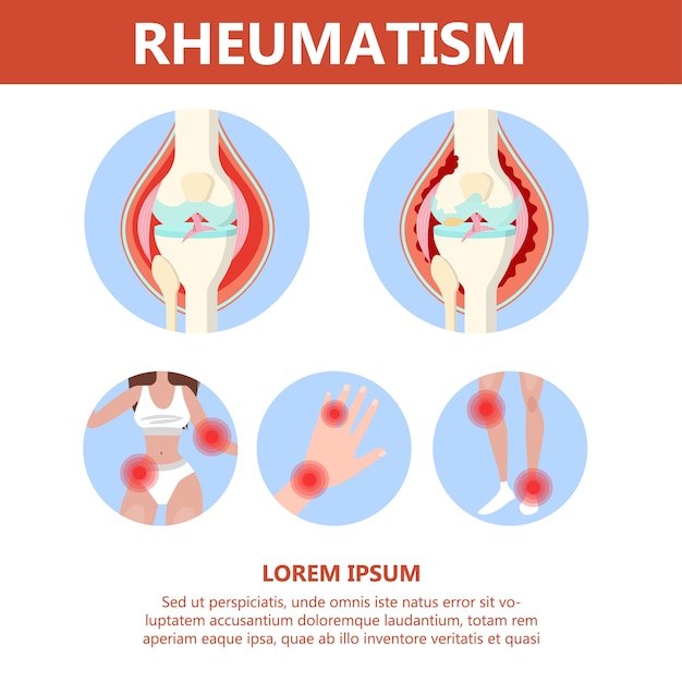 Infografica sui reumatismi. malattia ossea a piedi, mano