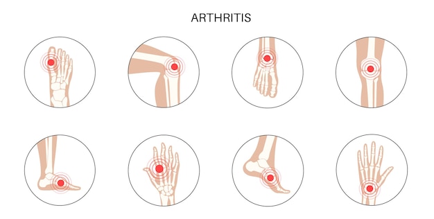 Rheumatoid arthritis, inflammation, bone disease concept.