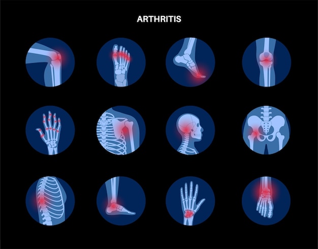 Rheumatoid arthritis, pain, bone disease concept.