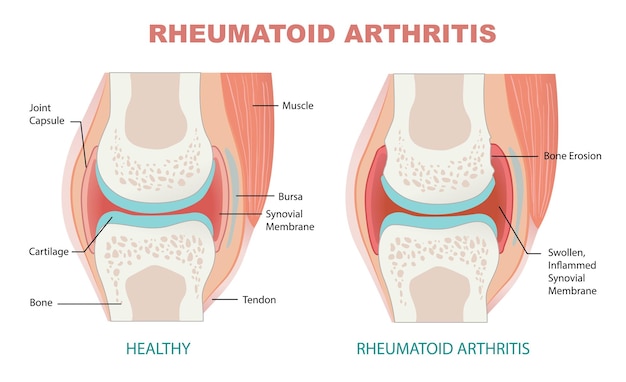 Vettore artrite reumatoide