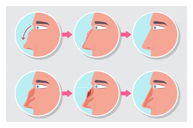 手技インフォグラフィック前後の鼻形成術