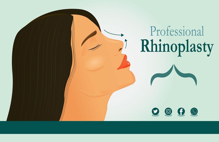 Vector rinoplastia