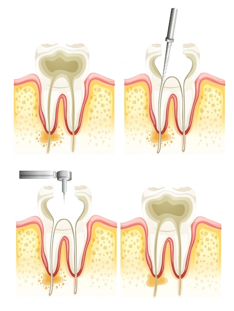 Vector root canal process