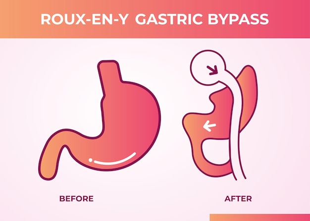 Vector roux-en-y gastric bypass (rny) weight loss surgery vector illustration icon