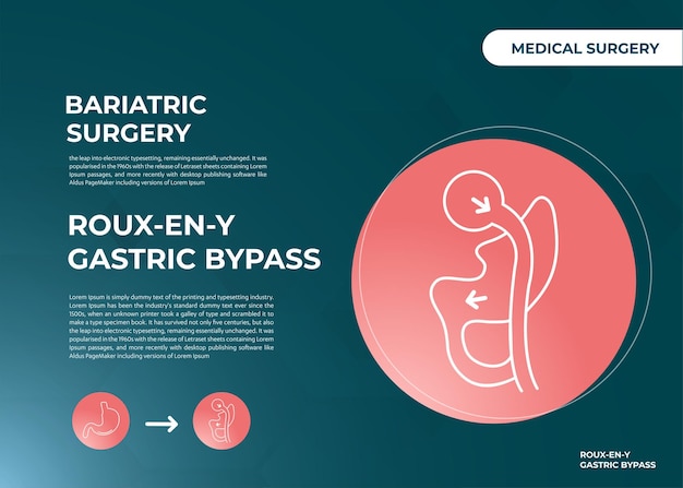 Roux-en-y bypass gastrico (rny) icona dell'illustrazione vettoriale della chirurgia per la perdita di peso