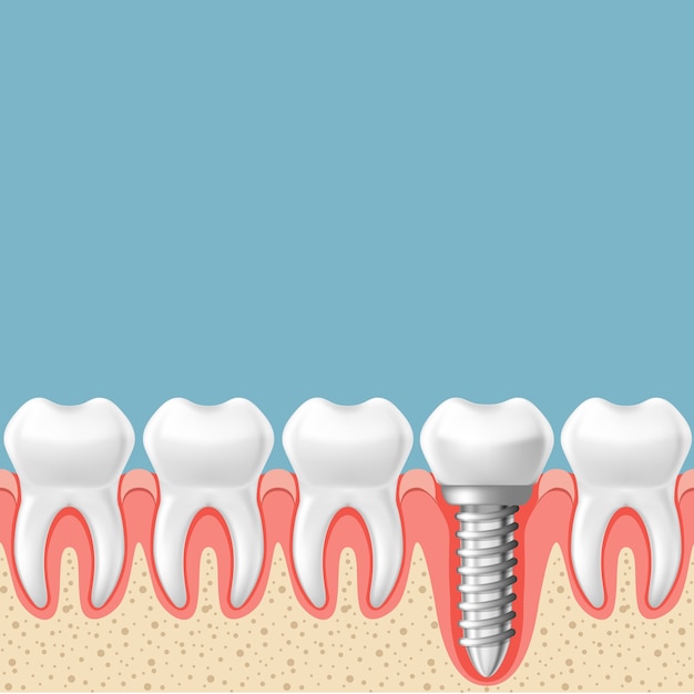 Row of teeth with dental implant - teeth prosthetics scheme, gum cut