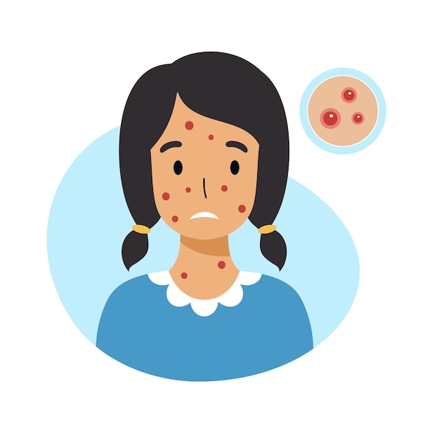 Vector sad  girl with chicken pox on her face. skin inflammation and acne in adolescents.