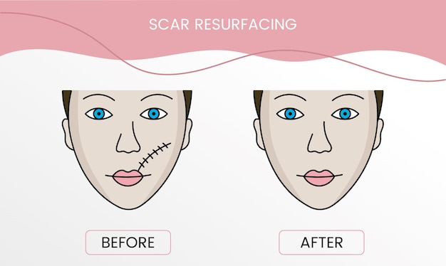 Scar resurfacing laser cosmetology before procedure and after applying treatment in vector Illustration of a woman with smooth clean skin and problematic skin