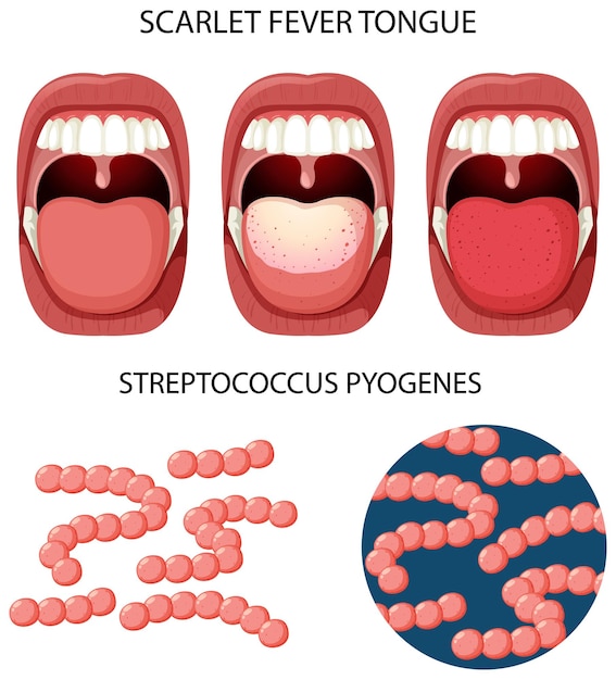 Scarlet fever tongue symptoms