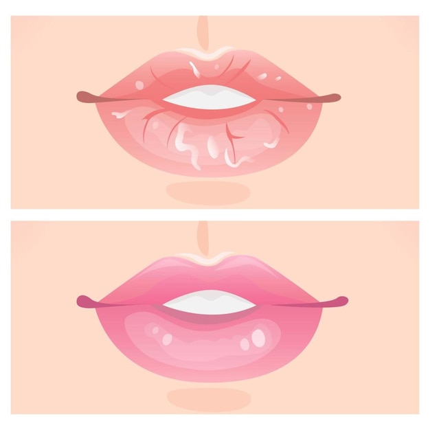 Vector schilferige lippen en mooie lippen