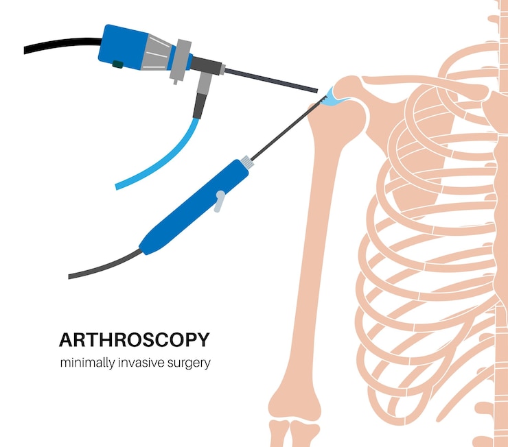 Schouder artroscopie procedure Rotator cuff tranen of schoudergewricht vervanging Minimaal invasieve chirurgie Ligamenten behandeling peesontsteking pijn of artritis ontsteking medische vector illustratie