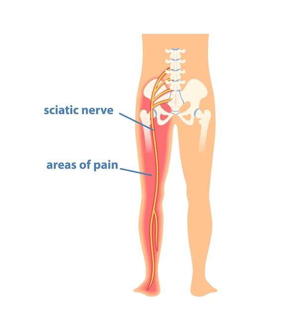 Sciatic nerve pinching concept