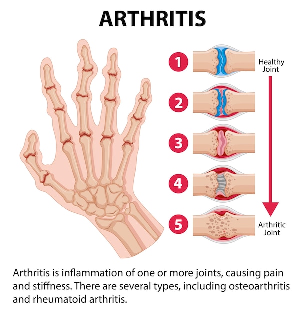 Educazione sull'anatomia umana infografica sulle fasi dell'artrite