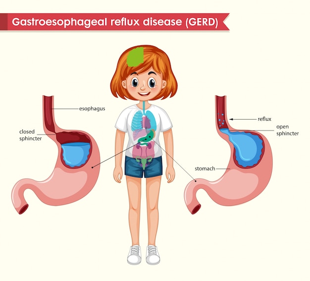 Vettore illustrazione medica scientifica di gerd