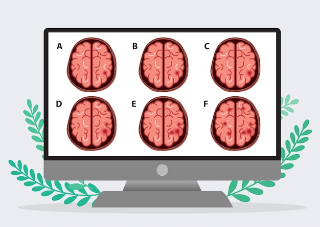 Vector scientific medical illustration of human brain stroke