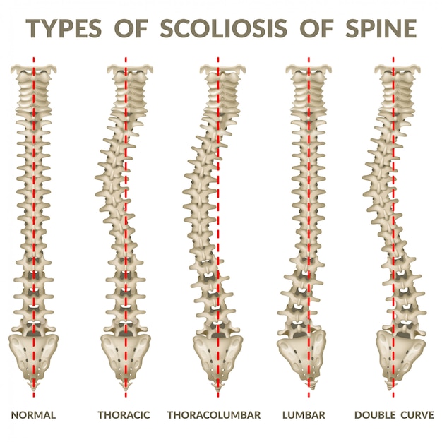 Vector scoliosis of spine