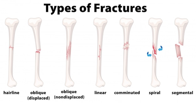 A set of bone fractures