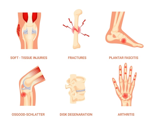 Set of Bones Disease SoftTissue Injuries Disease Fracture Disease Plantar Fasciitis Disease Osg