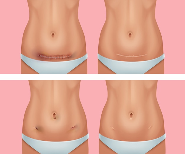 set of fresh and healed scars on body after abdomen wound
