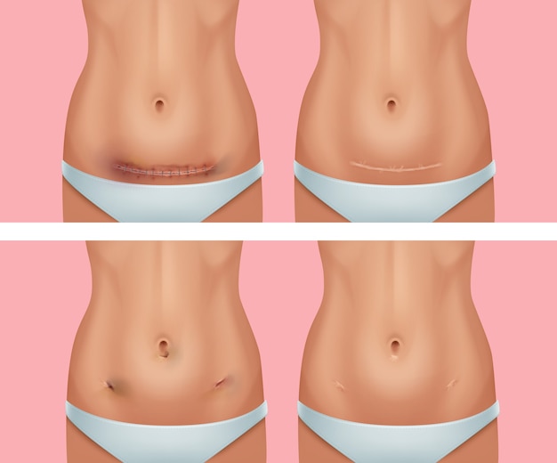 Vector set of fresh and healed scars on body after abdomen wound