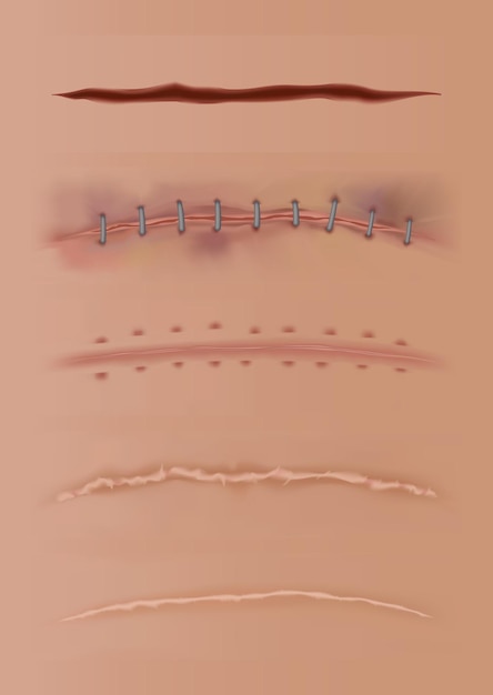 Vector set of healing wounds, skin scars, stitched gash and cuts. realistic surgical sutures, stitched wounds at different healing stages isolated on human skin background.