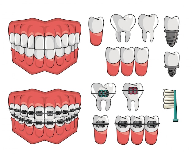 Набор элементов зубных брекетов