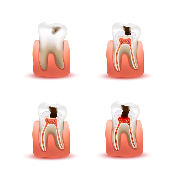 벡터 4 개의 다른 충치 단계, 화이트 infographic 차트와 인간의 이빨의 집합