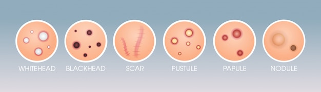 ベクトル セット皮膚傷跡ホワイトヘッド膿疱にきび丘疹丘疹にきびさまざまなにきびの種類顔毛面面体美容化粧品スキンケア問題コンセプトフラット水平