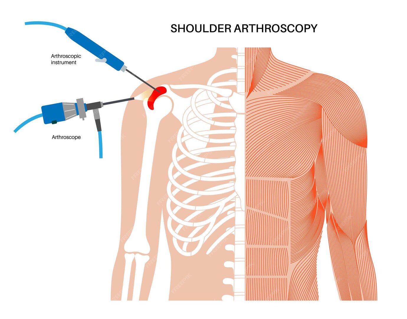Premium Vector Shoulder arthroscopy procedure rotator cuff tears