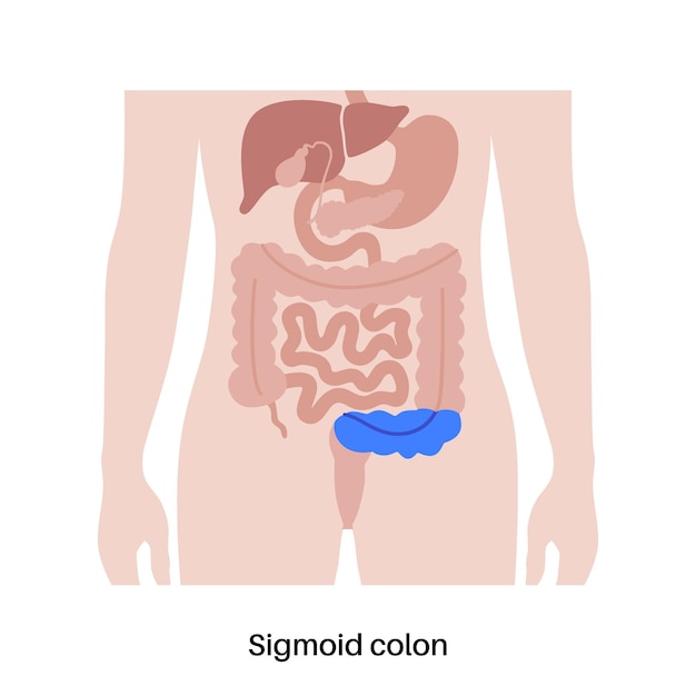 Sigmoid colon poster Large intestine in the human body Gastrointestinal disease diagnostic and treatment in gastroenterology clinic Digestive tract examination of bowel vector illustration