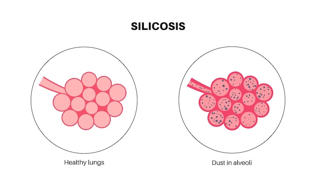 Vector silicosis dust in lung