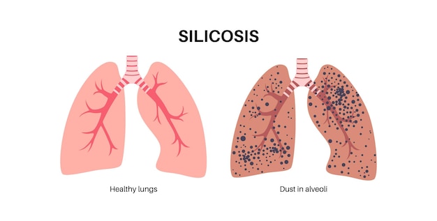 Vector silicosis dust in lung