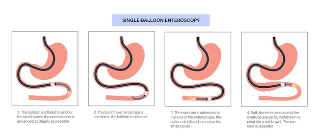 Vector single balloon enteroscopy procedure visualization of the small intestine nonsurgical technique gastrointestinal tract problem biopsy polyp removal bleeding therapy or stent placement flat vector