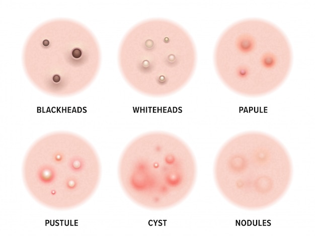 Set di tipi di acne della pelle
