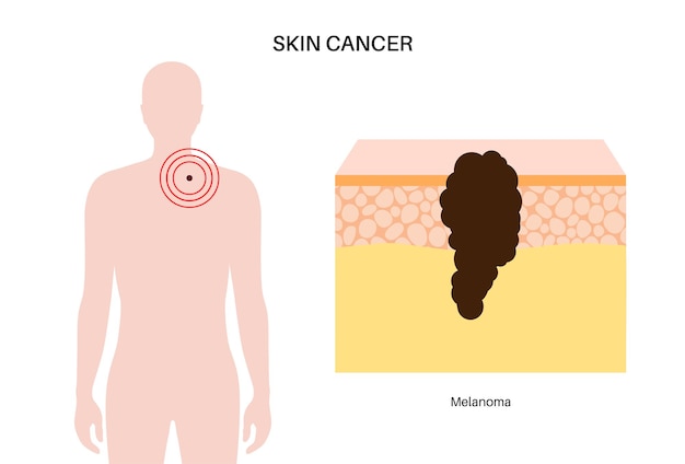 Vettore diagnosi del cancro della pelle