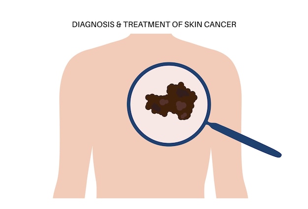 Vector skin cancer diagnosis