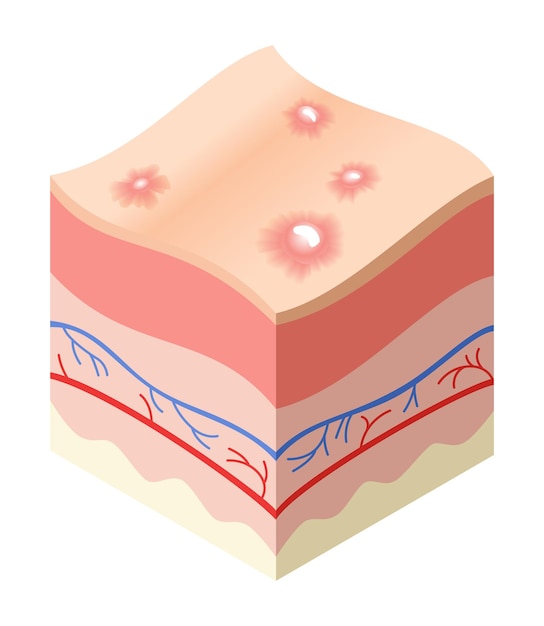 Skincare medical concept problems in crosssection of human skin horizontal layers structure anatomy illustrative model unhealthly layer of skin