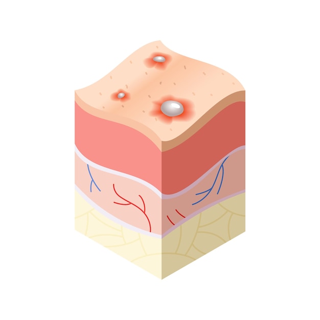 Вектор Медицинская концепция ухода за кожей. проблемы поперечного сечения строения горизонтальных слоев кожи человека. иллюстративная модель анатомии.