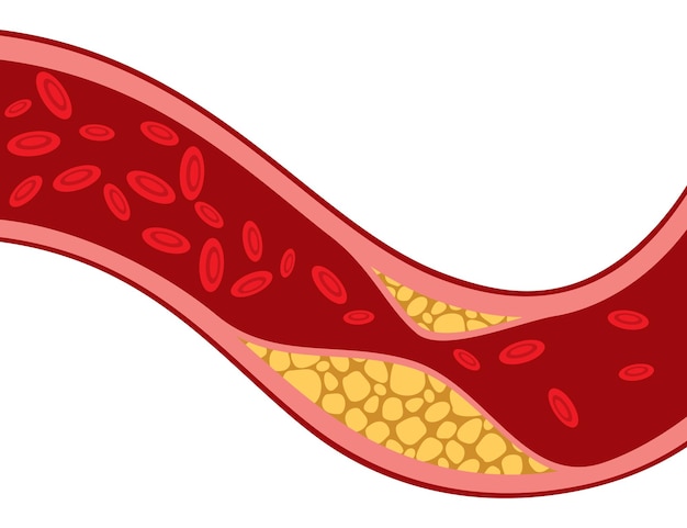 Slagader verstopt met cholesterol