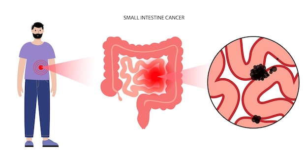 Small intestine cancer