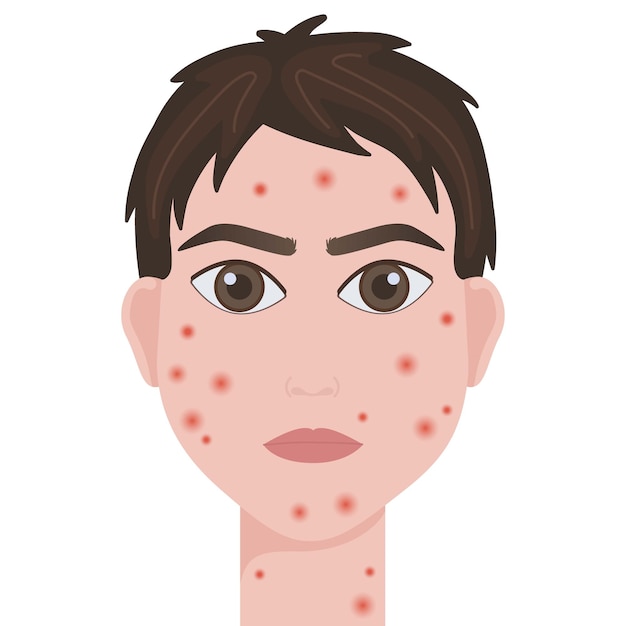 Vector smallpox virus vector illustration of smallpox virus monkeypox