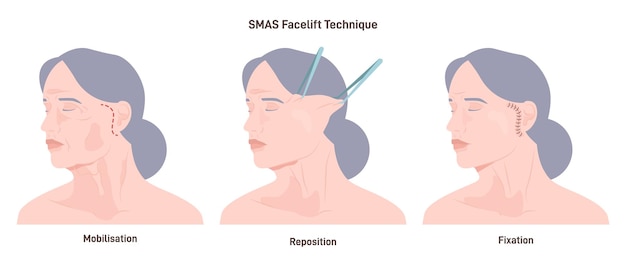 Vettore operazione di facelift smas correzione delle caratteristiche facciali o procedura anti-invecchiamento