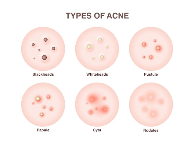 Vector soorten acne, puistjes, huidporiën, mee-eter, whitehead, litteken, comedo. iconen van acne huid puistjes, cosmetologie en huidverzorgingsproblemen.