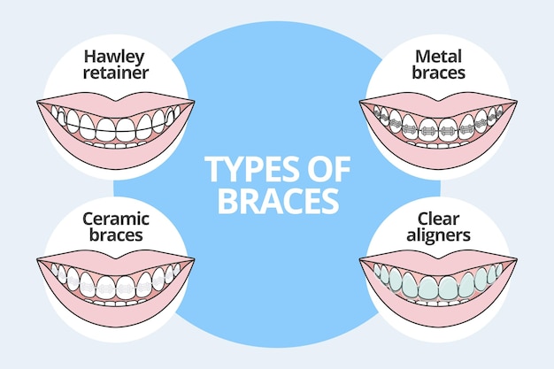 Soorten beugels orthodontie vectorillustratie