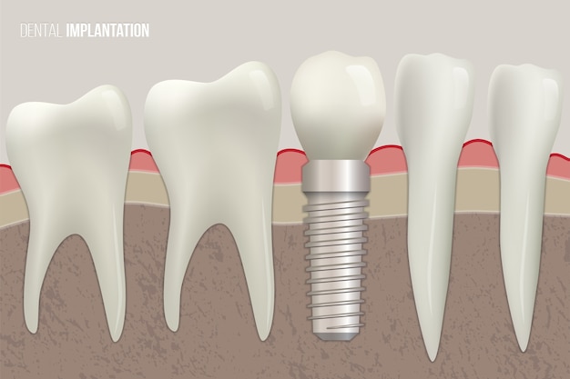 Denti sani e impianto dentale sull'illustrazione medica.