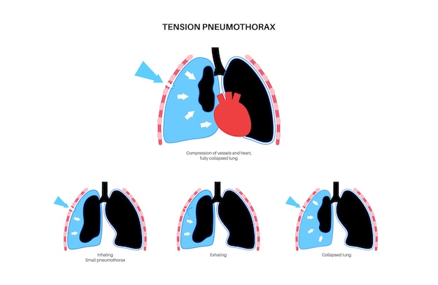 Vector spanningspneumothorax poster