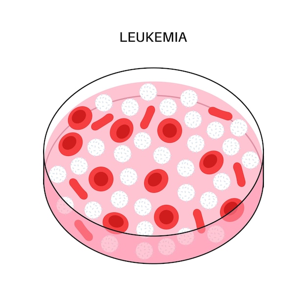 Specimen met leukemieziekte. bloed kanker concept. structuur van menselijke bloedcellen.