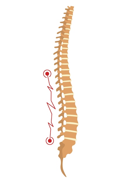 Deformità spinale simbolo di curvature della colonna vertebrale o spine dorsali malsane anatomia della colonna vertebrale umana curvatura della colonna vertebrale diagramma con sezione contrassegnata difetto di postura del corpo