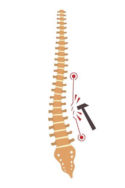 Vettore deformità spinale simbolo di curvature della colonna vertebrale o spine dorsali malsane anatomia della colonna vertebrale umana curvatura della colonna vertebrale diagramma con sezione contrassegnata difetto di postura del corpo
